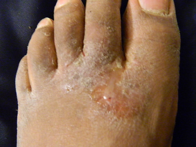 uddanne oversætter flertal Athlete's Foot - Pariser Dermatology