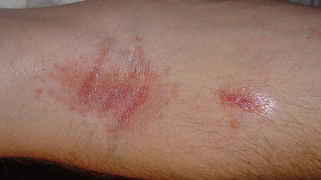 allergic contact dermatitis poison ivy