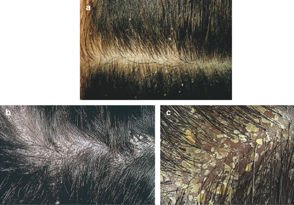 Dry Scalp And Hair Loss: Are The Two Connected? | Longevita