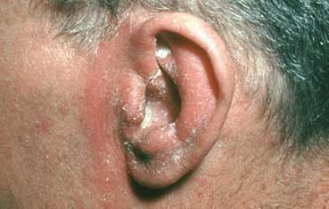 crusty eczema behind ears