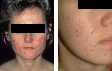 dermatologist with acne patient