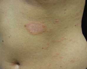 Pityriasis Rosea - Pariser Dermatology