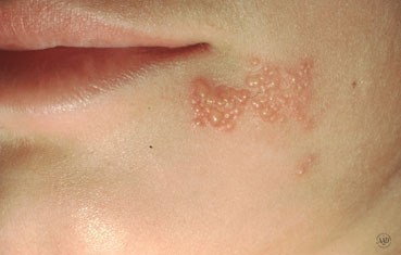 herpes simplex under eye