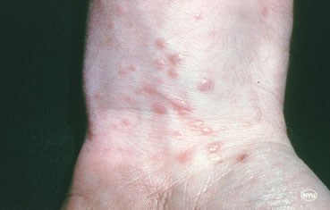 Lichen Planus Specialist Advice