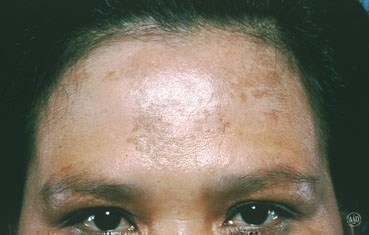 Melasma - Pariser Dermatology