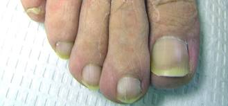 What Works Best For Toenail Fungus