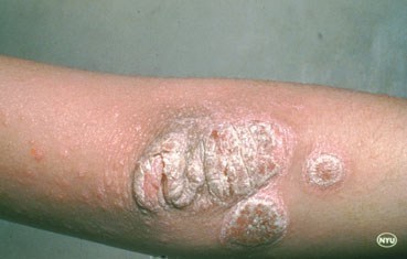 Psoriasis