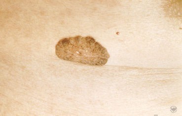 barnacle skin cancer