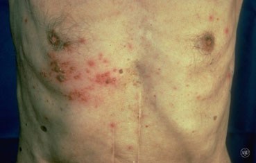 herpes zoster symptoms