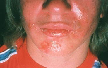 Sunburn Herpes Simplex 