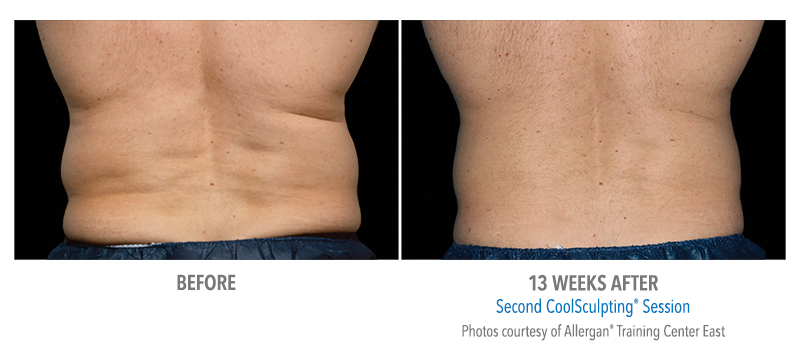 coolsculpting-before-and-after-pariser-dermatology