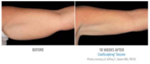 coolsculpting-before-and-after-results-pariser-dermatology
