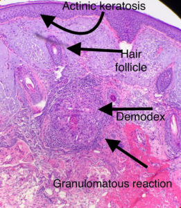 Demodex image