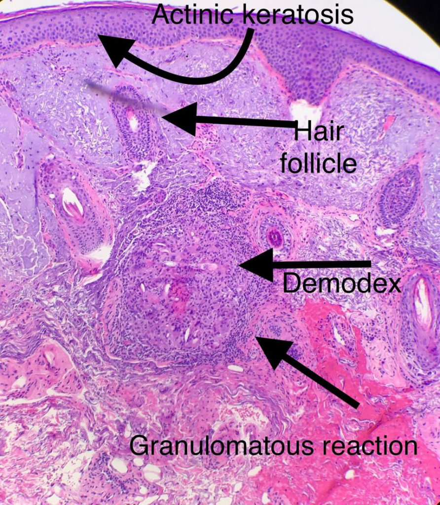 Demodex Mites Live On Our Skin Pariser Dermatology 7175