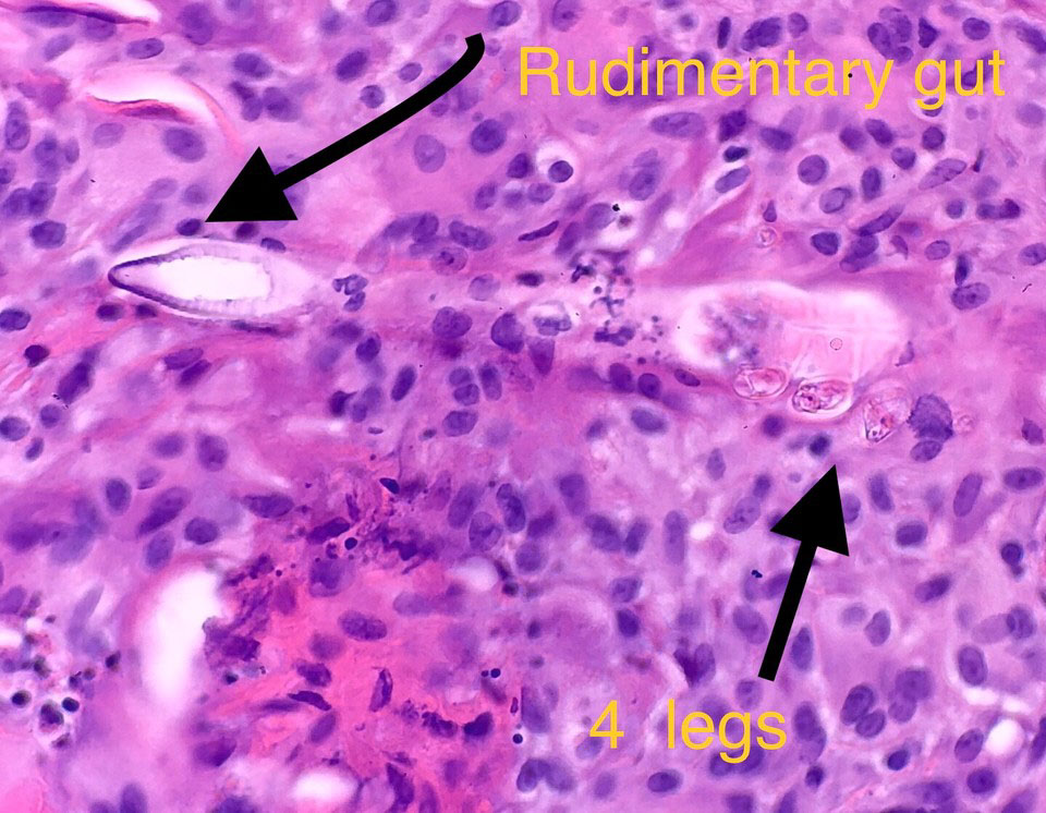 demodex mites