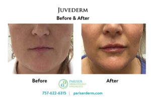 Juvederm Lips Before and After at pariser dermatology specialists in hampton roads