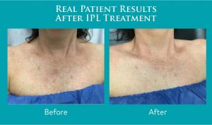 Before and After IPL treatment