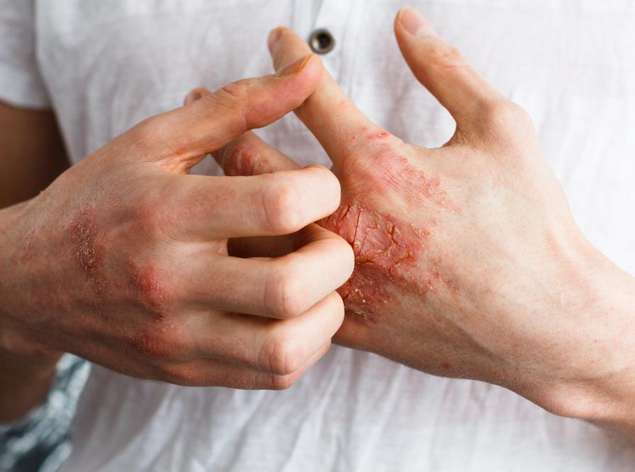 Controlling Your Eczema During the Winter - Pariser Dermatology