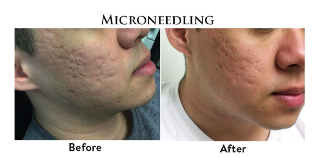 microneedling