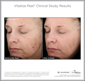 Vitalize Chemical Peel