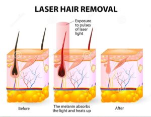 Laser Hair Removal