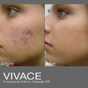Vivace RF Microneedling treats acne scars