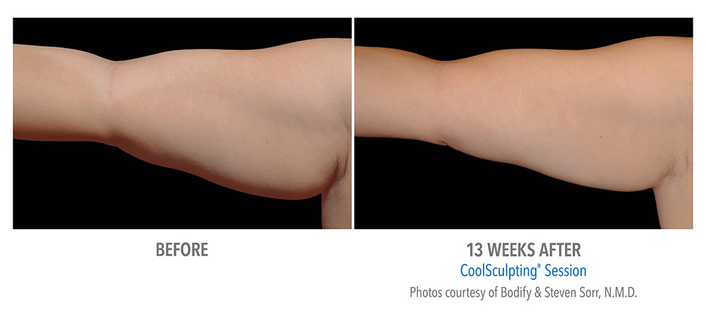 CoolSculpting the Arms