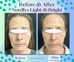 Nordlys Light & Bright IPL device