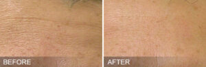 Hydrafacial for fine lines