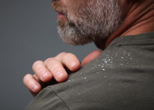 Man with dandruff on his shirt