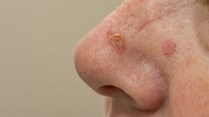 Actinic keratoses on the face