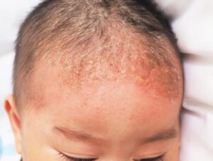 Seborrheic Dermatitis or cradle cap in babies