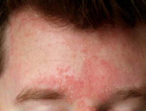 Seborrheic dermatitis causing redness and flaky scales on the scalp and forehead